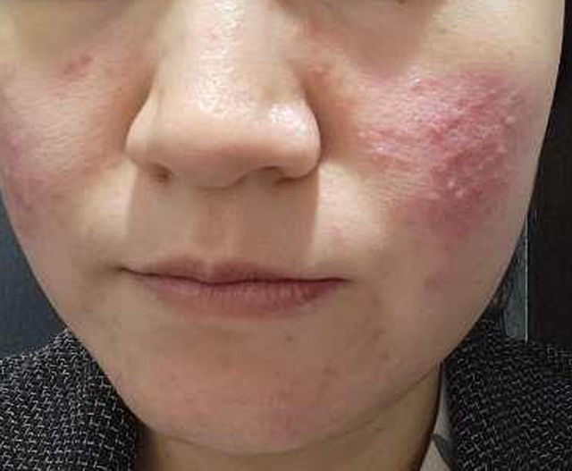 38세 여성 · 3개월 경과 · 치료 전