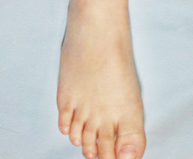6세 남아 · 2개월 경과