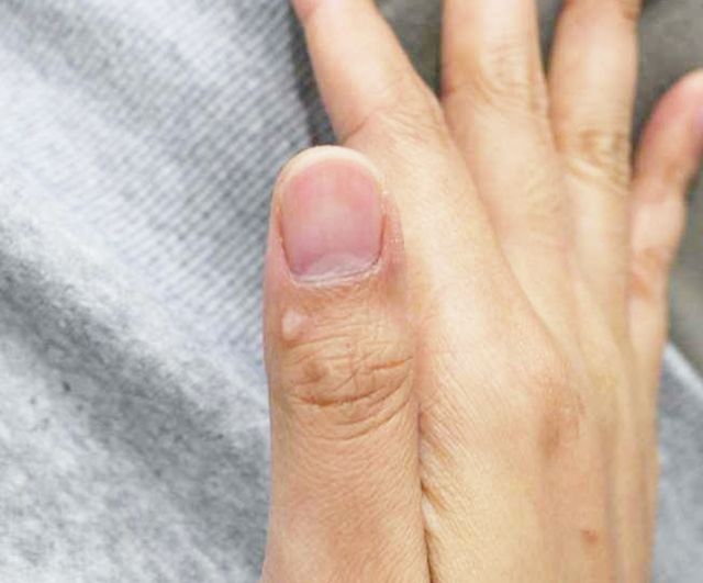 37세 남성 · 7개월 경과 · 치료 전