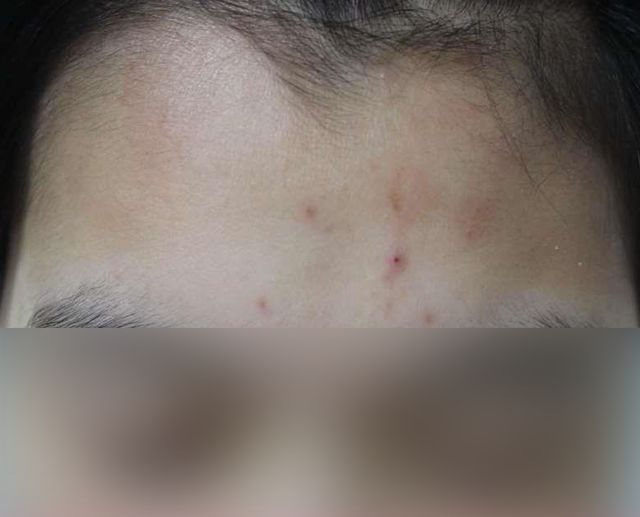 20세 여성 · 3개월 경과