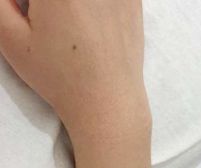 30대 여성 · 4개월 경과